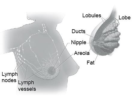 Breast Cancer Overview Definition of Breast Cancer: Cancer