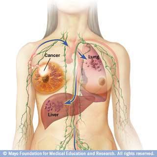 such as bones, organs or lymph nodes far from your breast.