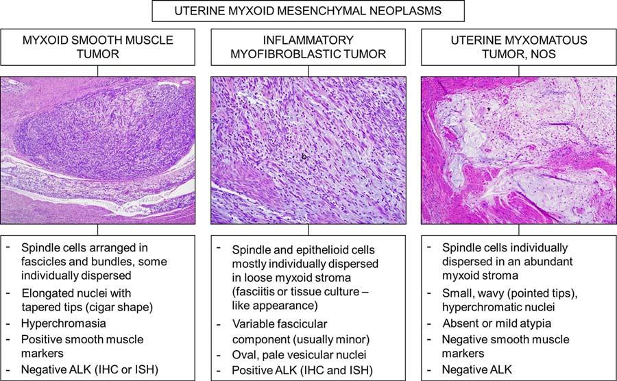 Am J Surg Pathol Volume 40, Number 3, March 2016 Myxoid Leiomyosarcoma of the Uterus FIGURE 8. Differential diagnosis of mesenchymal myxoid tumors of the uterus and relevant histopathologic features.