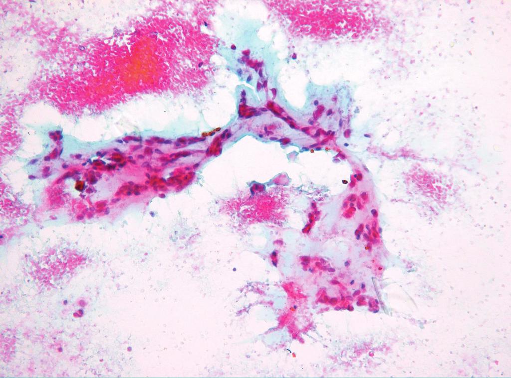 (A) Large three-dimensional tissue fragments in a hemorrhagic background are noted.