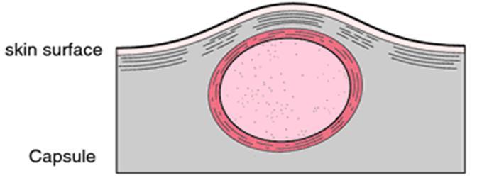 Benign tumours The cancer cells are enclosed in a capsule.