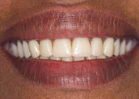 Figure 1: Pre-op smile with conventional maxillary complete denture in position Case 1 The first case demonstrated here involves a female patient who had worn a conventional maxillary complete