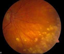 Uveitis: phase I/II non-randomized open label study with long term followup Liver injury Cytopenias Daclizumab (Zenapax) (HAT) antibody--90% human FDA approved for the prevention of renal allograft