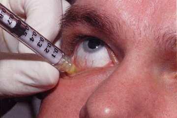 Chlorambucil Therapy: Principles Define why vision is down.