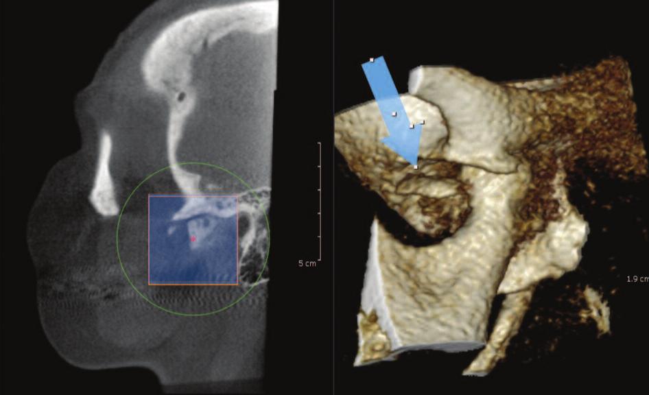 lateral pole of the condyle (white arrow, top image and blue arrow,