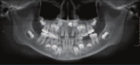 malformation such as an odontoma.