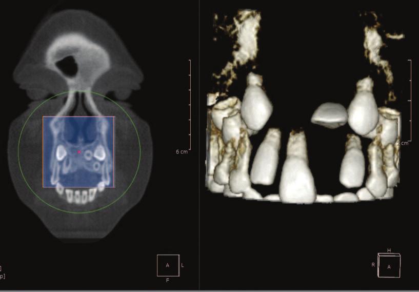 Figure 2c: (left) 3D color reconstruction using a Cube tool in OnDemand 3D third party software (CyberMed International, Seoul, Korea) shows the sub-mucosal position of developing teeth #6, 9,
