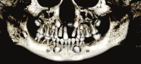 Figure 2d: A 3D color panoramic reconstruction shows all tooth relationships and root development.