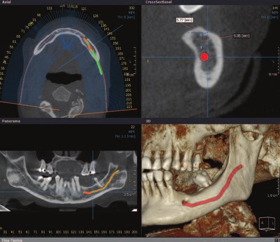 Figure 3a: (left) Multiple views of a proposed implant site.