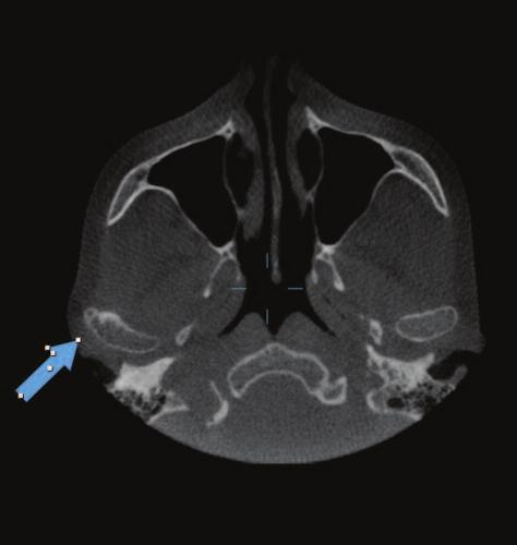 Figure 4a: Axial slice through the mid-condyle region showing a cystic lesion on