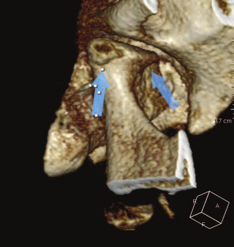 Figure 4b: 3D color reconstruction of the right TMJ condyle and related bony