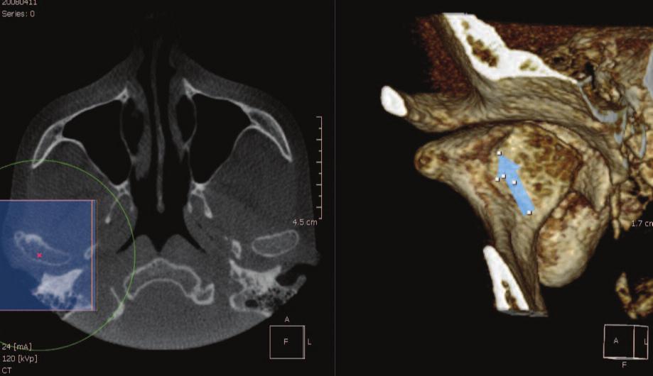 pole as well as some osteophyte formation on the anterior surface (blue arrows).