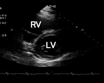 was normalized after thiamine administration right. RV right ventricle; LV left ventricle. 1 2 5 l/min PaO 2 60mmHg 70 mmhg Swan-Ganz 6 g/kg/min 84/55 mmhg 70/38mmHg16 mmhg 6.