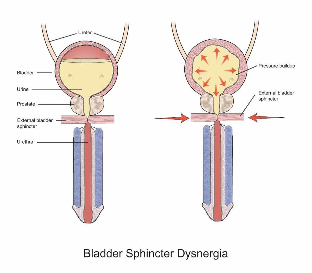 Bladder-Sphincter Dysnergia