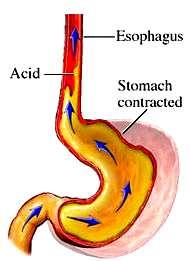 Reflux of gastric contents,