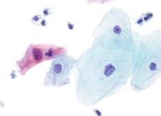 Co-testing HPV and Cytology for All Cytology NILM / HPV- ASC-US / HPV- Routine screening 31 33 35 NILM