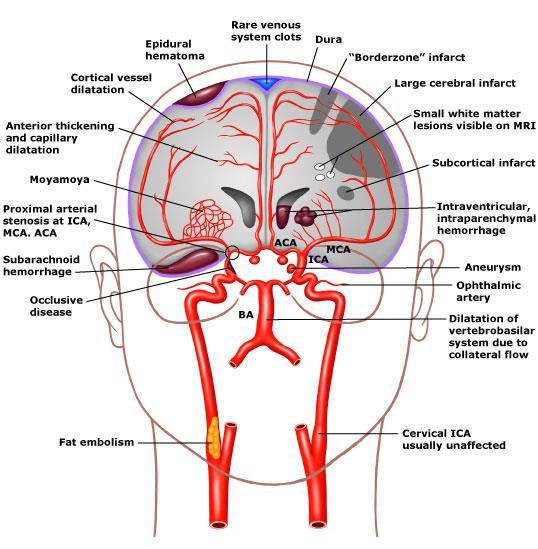 Prevention of stroke Cerebral vasculopathy Stroke (Ischemic or