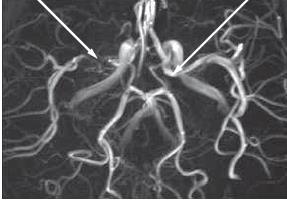 in the internal carotid and middle cerebral arteries