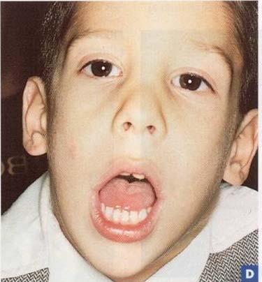 Adenoid facies: Long face syndrome Features vertical height of upper face high