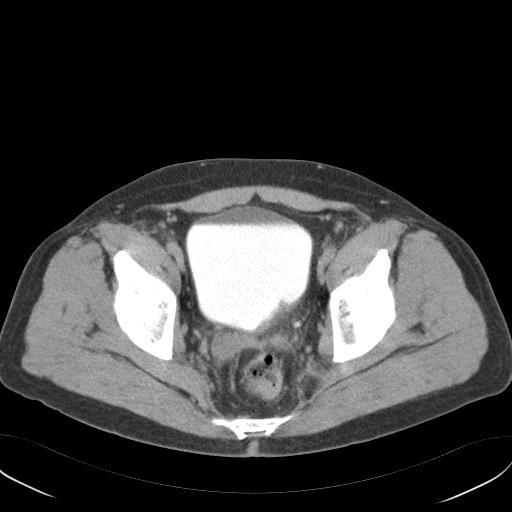 Recurrent High Grade Bladder 58y/o man with 4 yr Hx microhematuria, not evaluated Presented with gross hematuria Cysto shows BT, resection