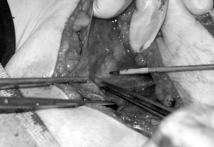 Usefulness of modified incision MATERIALS AND METHODS From March 2005 to December 2007, 95 patients with early stage cervical cancer who received radical hysterectomy and pelvic lymphadenectomy at