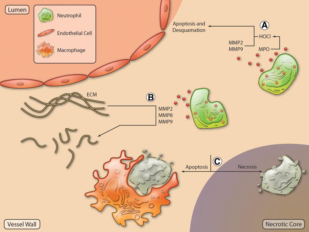 882 Circulation Research March 16, 2012 Figure 3. Possible mechanisms of neutrophil-driven plaque destabilization.