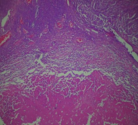 Chemotherapy Research and Practice 3 Figure 3: Sections showing extensive inflammation (H & E 100). on neoadjuvant chemotherapy induced histopathological changes of ovarian cancer.