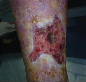Due to the patient s underlying disease, it was imperative that he remained free from infection.