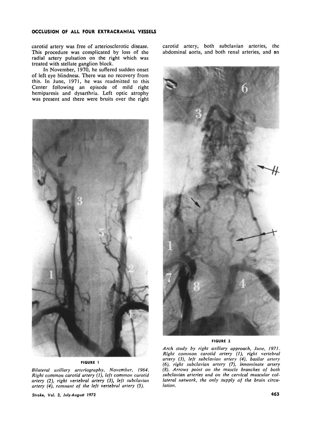 OCCLUSION OF ALL FOUR EXTRACRANIAL VESSELS carotid artery was free of arteriosclerotic disease.