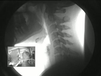 NAME OF PATIENT: CASE STUDY 4 DATE OF REPORT: DATE OF EXAMINATION: REFERRING PHYSICIAN: TESTING FACILITY: Digital Motion X-ray Cervical Spine 1.