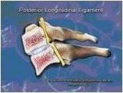 Widening of posterior disc space Anterolisthesis The integrity of the