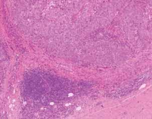 Medullary BRCA1 methylation Metaplastic