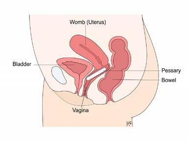 Some common pessaries shown above Image of a ring pessary in place Prolapse is a feeling of vaginal heaviness or vaginal bulging which may include bladder and bowel problems of not emptying or