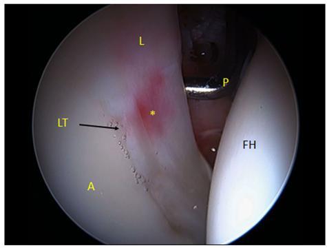 Methds The indicatins fr an IFL included painful internal snapping f the hip in the patient s histry r physical exam and/r the presence f an ilipsas impingement lesin defined as a labral tear at the