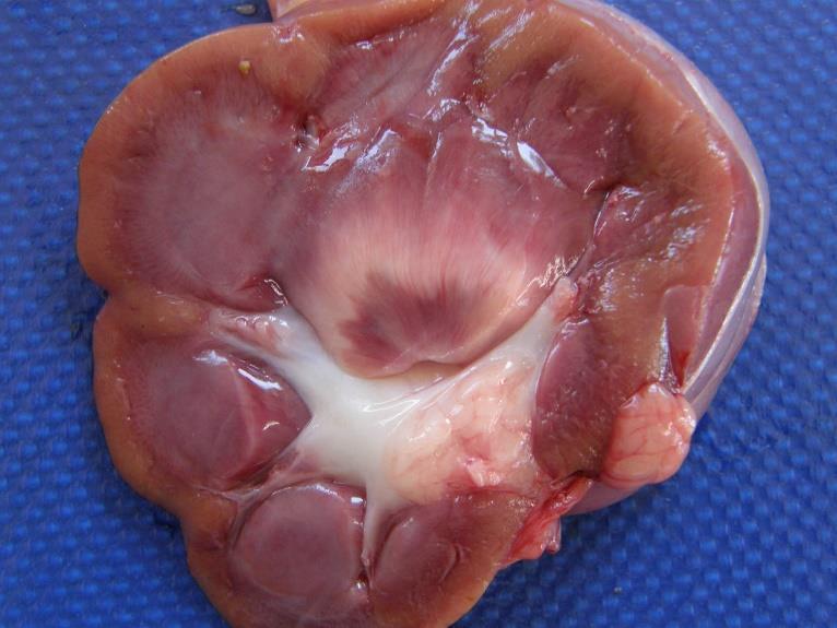 Renal pelvis frequently contains purulent debris and there may be erosion of the surface of the pelvis and medulla.
