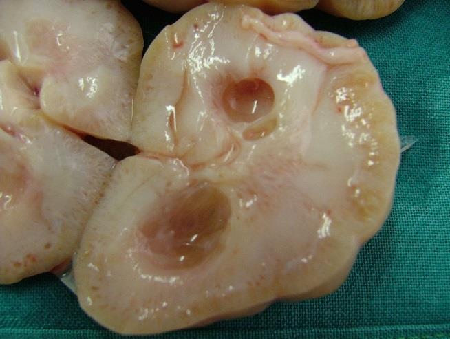Kidneys are small with distorted shape/architecture and frequently with fetalisation (Figure 14), as noted in