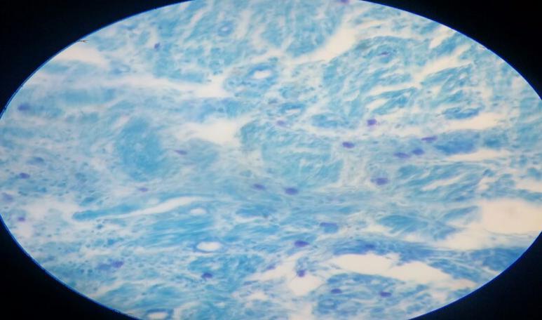 (table- 2, 3) Figure-2 chronic appendicitis figure-3 mast cell in acute appendicitis, toluidine blue 400x Figure-1 acute appendicitis figure-4 mast cell in chronic appendicitis, toluidine blue 400x