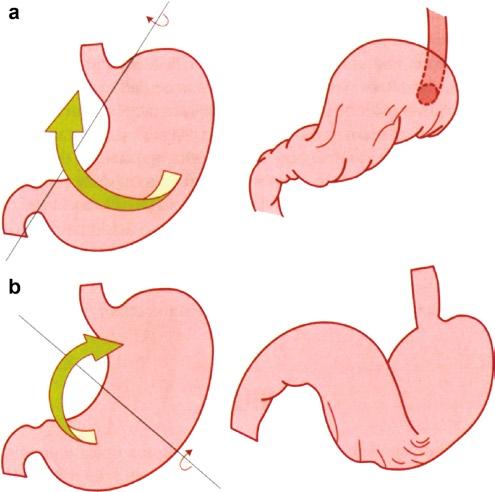 2 Paraesophageal Hiatus Hernia 19 junction migrates into the mediastinum through the widened hiatus; a portion of the lesser curvature of the stomach accompanies the esophagogastric junction and