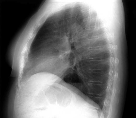 22 L. Bonavina Diagnosis A paraesophageal hiatus hernia is often suspected on the basis of an abnormality on an incidental chest x-ray because of a retrocardiac air bubble with or without an