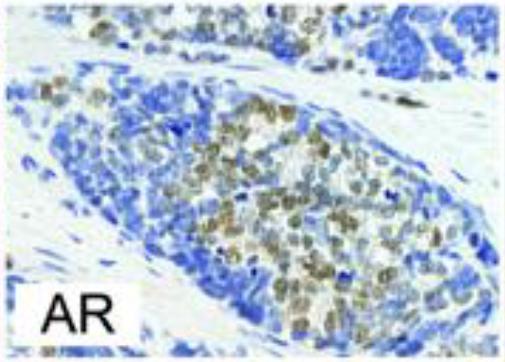 tumour cells AR positive tumour cells