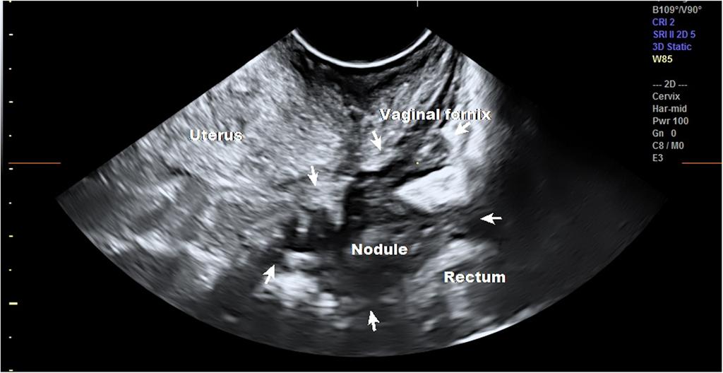 Eisenberg et al. Gynecological Surgery (2017) 14:19 Page 6 of 10 Fig. 3 TVUS of a large vaginal nodule extending to the rectosigmoid.