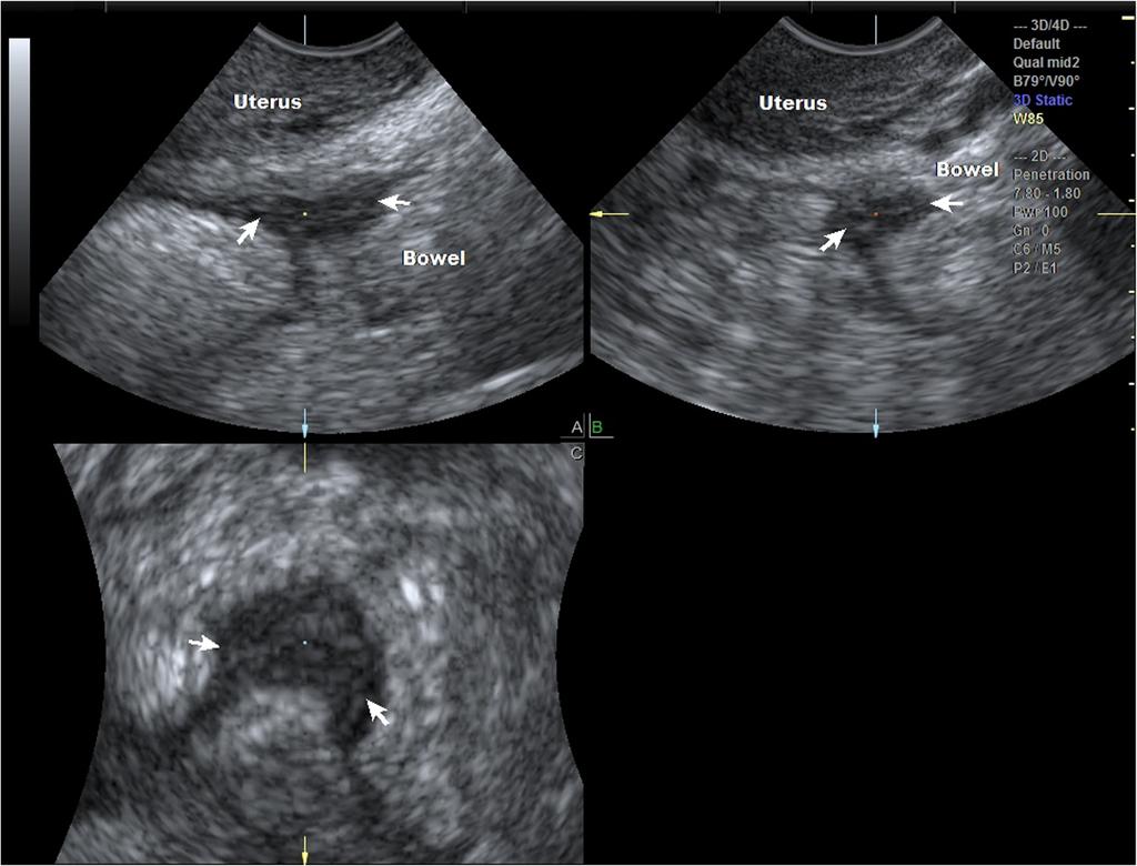 There were four false positives by the sonographer. Based on the LU-CUSUM curve, it takes the sonographer 31 examinations to become proficient at diagnosing pouch of Douglas obliteration correctly.
