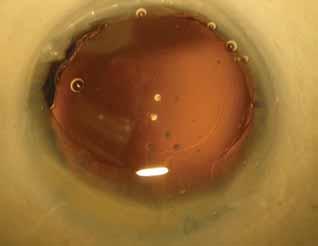 Figure 16. The Digital Light Delivery Device for the Light Adjustable Lens. Figure 15. The SmartIOL implanted in a human cadaver eye. Figure 18. The LiquiLens when positioned for near vision.