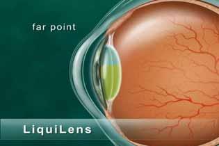 After implantation into the human eye, the power of the Light Adjustable Lens (LAL; Calhoun Vision, Inc., Pasadena, California) can be altered.