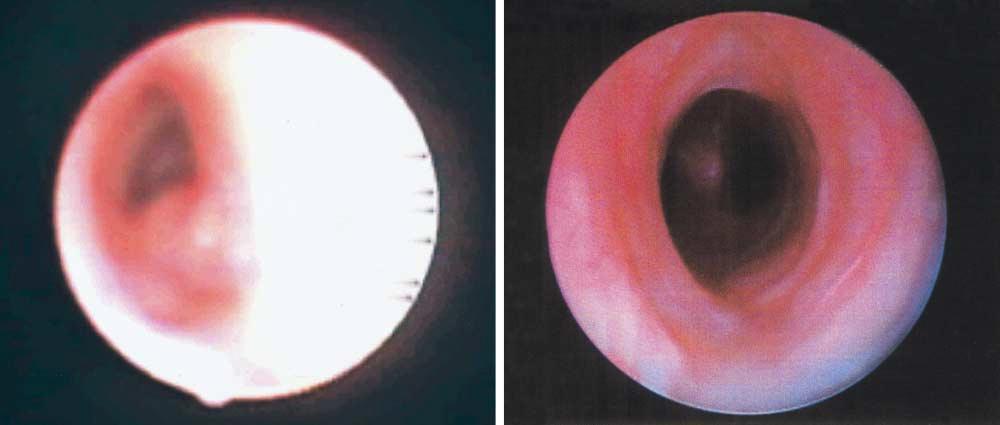 Tracheal stenosis viewed during flexible  A B Figure 3.