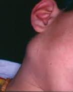 other elements Drainage to nearby lymph nodes; hence causing