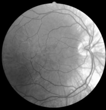 dependent on degree of: Foveal hypoplasia (major factor affecting acuity) Can be appreciated on ophthalmoscopy and with macular OCT scan Amelanosis of iris and retina