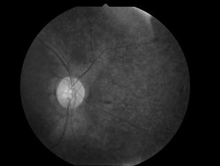 Night vision and peripheral field loss in early childhood,