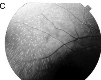 2008 Retinitis Punctata Albescens Systemic Syndromes Invest. Ophthalmol. Vis. Sci.