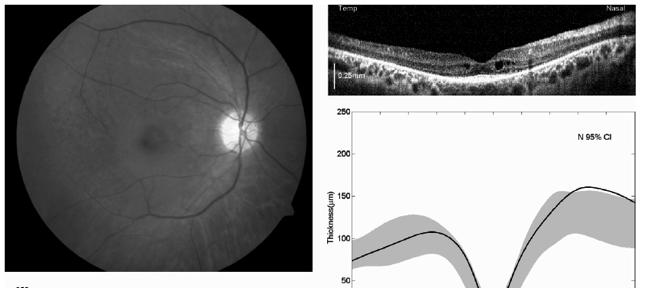 atrophic looking retina) May be just early stage of disease Arterial attenuation